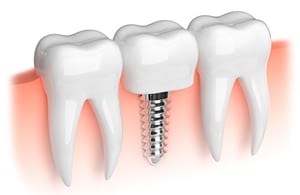 dentalutrera-clinicadental-implantes