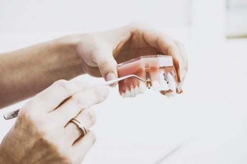 DIENTES, ¿QUÉ PASA SI ME FALTAN ALGUNOS?